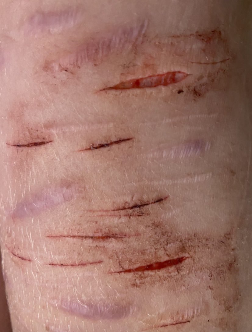 plutoast4's tweet photo. here’s some recent spam just to meet some new people on shtwt
THIS IS ALL MAKEUP/SFX
🖤
🖤
🖤
🖤
🖤
🖤
🖤
🖤
🖤
🖤
🖤
🖤
🖤
🖤
🖤
🖤
🖤
🖤
#shtwt #beanstwt #armgills #madeofstyro #madeofstyrofoam #styro #sliceytwt https://t.co/EOwxLefvcU