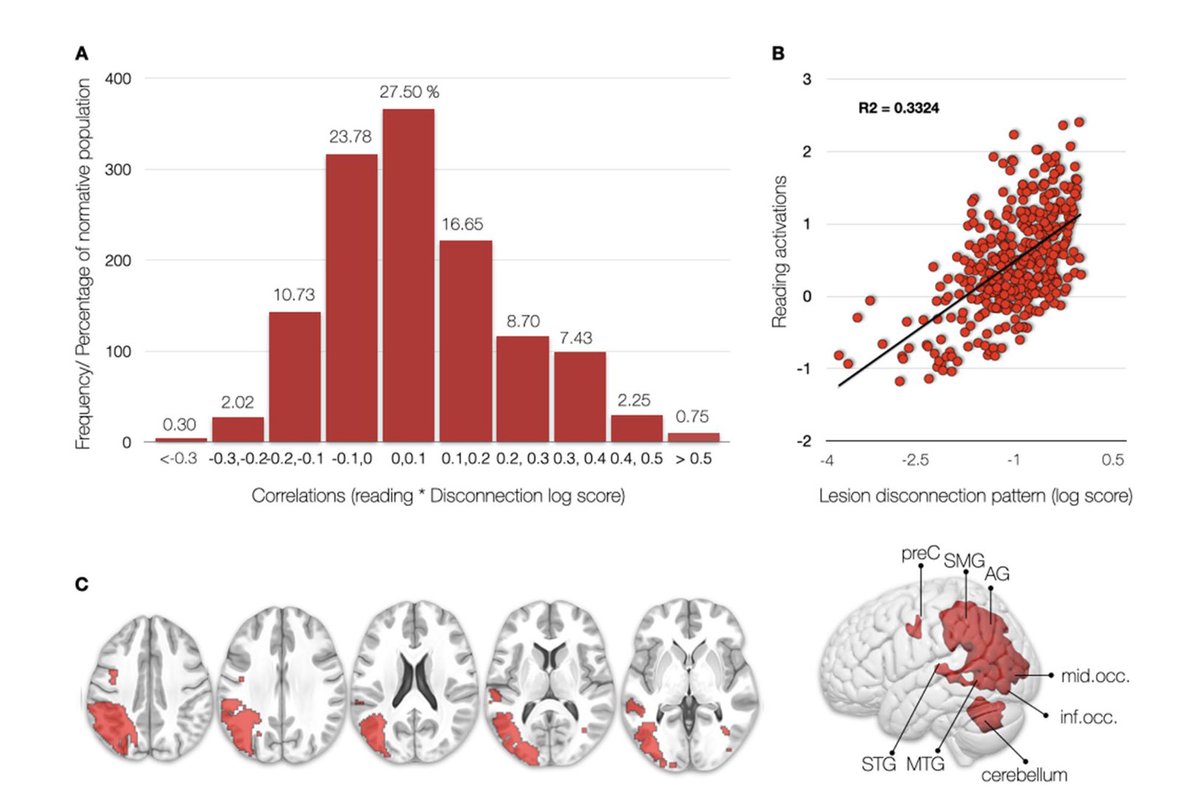 #Stroke #disconnectome decodes #reading #networks. This study builds on novel methods to elucidate structure-function relationships by leveraging #lesion data - An analytical framework for other cognitive domains rdcu.be/cWQD4 

#Language #Disconnection #fMRI #anatomy