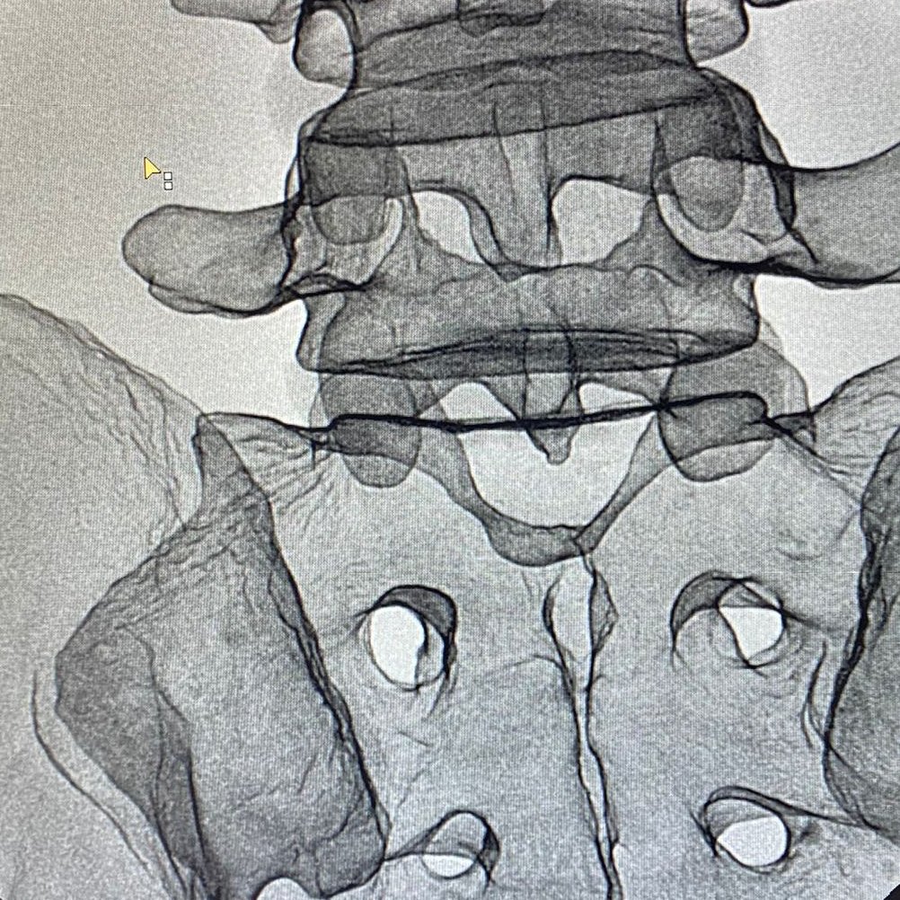 spineinjections's tweet photo. En @aliviamclinic1 te ofrecemos formación individualizada en intervencionismo del dolor en región lumbar. Dispondrás de formación teórica y practicas sobre simulador @3bscientific y sobre pacientes reales de la mano de instructores de @SISPhysicians. Contáctanos para más info. https://t.co/xIguhWvaDC