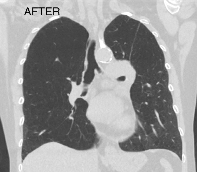 Not everyone is a candidate for #BLVR but for those who are a noticeable improvement in lung function can be achieved. The below is probably the best result I’ve seen so far after a staged bilateral BLVR. (Results obviously vary from one patient to another)