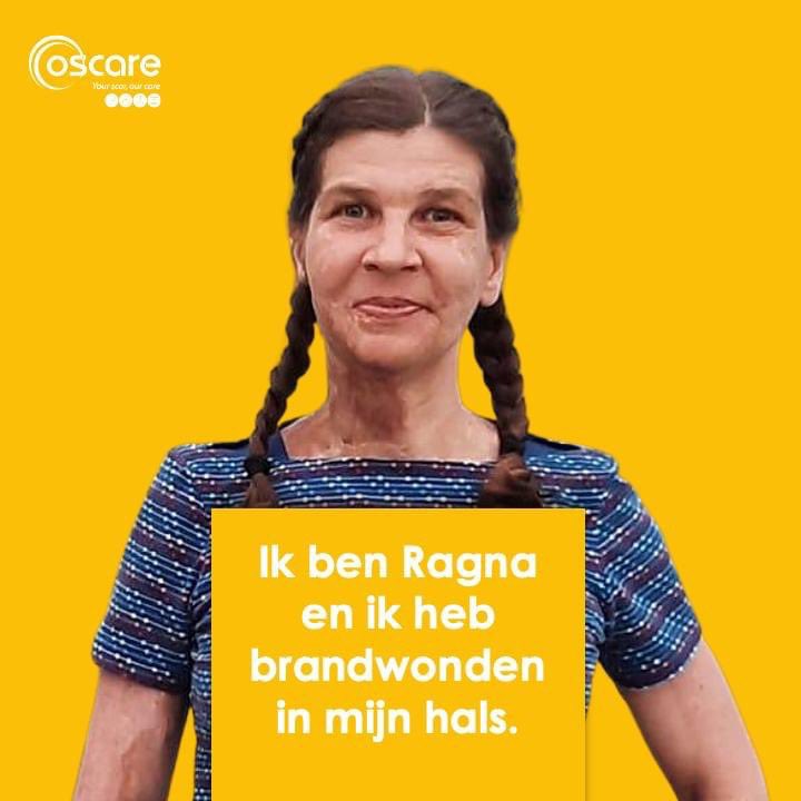 vzwOscare's tweet photo. Het doet er niet toe of je brandwonden hebt. Iedereen is uniek en mooi op zijn manier. 

Iedereen verdient de beste nazorg. Met onze campagne willen wij zorgen dat iedereen die nazorg ook krijgt. 

#oscare #toeternitoe #meetegenkansarmoede 

>> lees meer: https://t.co/i746WQZ0SW https://t.co/yKF5C9dKYV