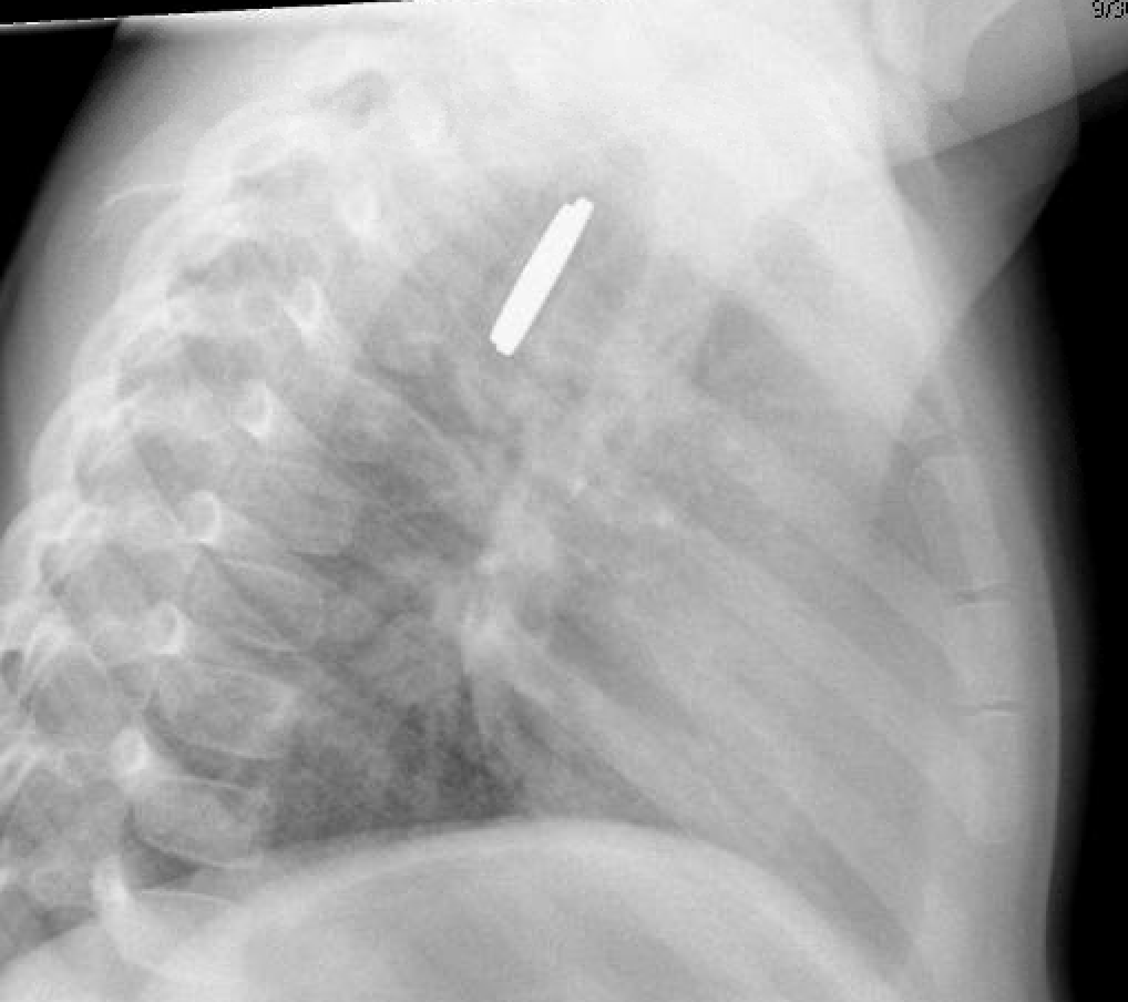 #PedsGI #GItwitter-  What do you think? Rush in to get this foreign body out ASAP or can it wait?