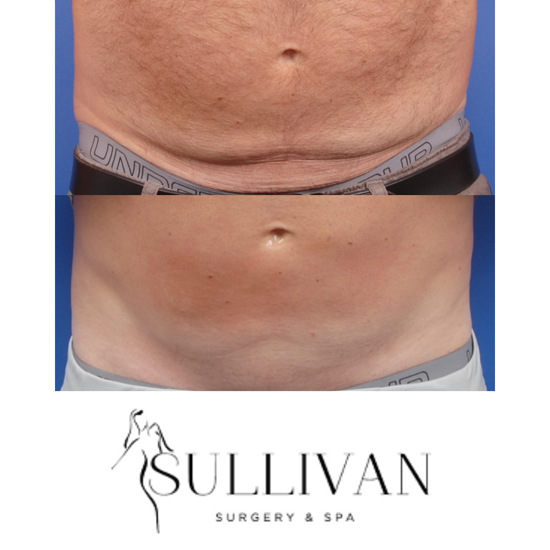 Sullivan1K's tweet photo. SKIN TYTE TUMMY!

Would you believe this is from a laser if I told you ?

"The powerful results of SkinTyte can be used to improve the appearance of severe wrinkles and mild-to-moderate sagging; restore a youthful contour of the face or body; and even help delay or eliminate the https://t.co/MsqfZLxcKf