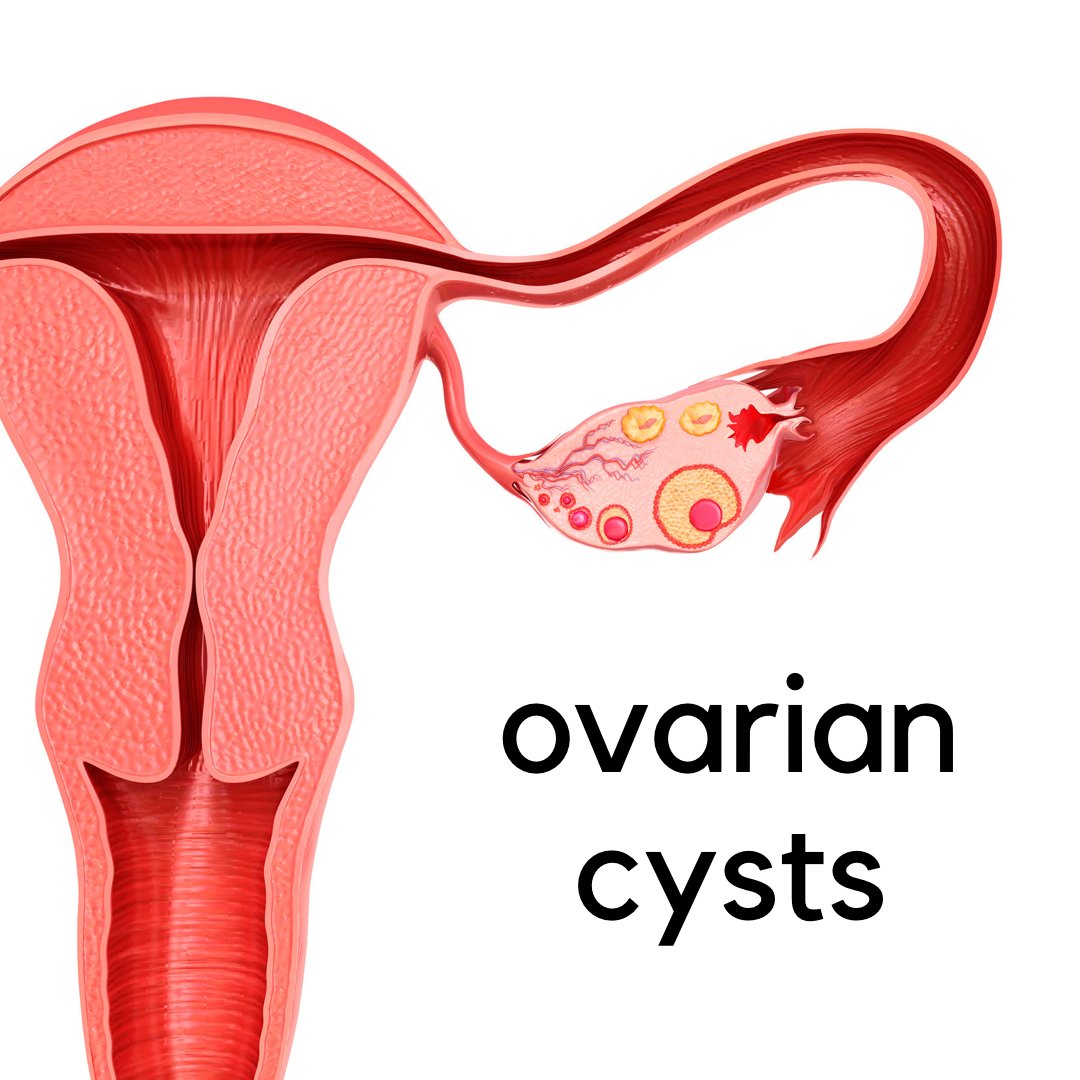 Have you ever heard of a dermoid cyst? A dermoid cyst is a cyst that is composed of hair, skin, or teeth. These cysts are more common between ages of 20 and 40. Rarely, these cysts are cancerous.