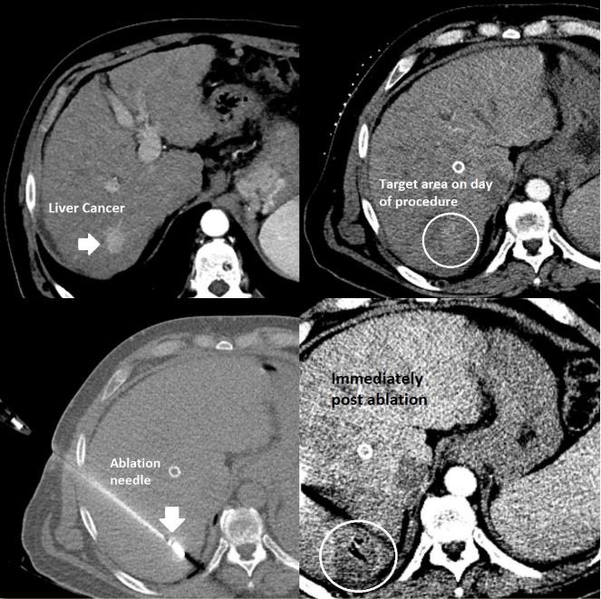 Interventional radiology (#IRad) is an important partner in caring for patients with liver disease, from relieving portal hypertension to opening obstructed bile ducts to killing #cancer. This small #cancer was burned to death via a small needle placed under CT guidance.