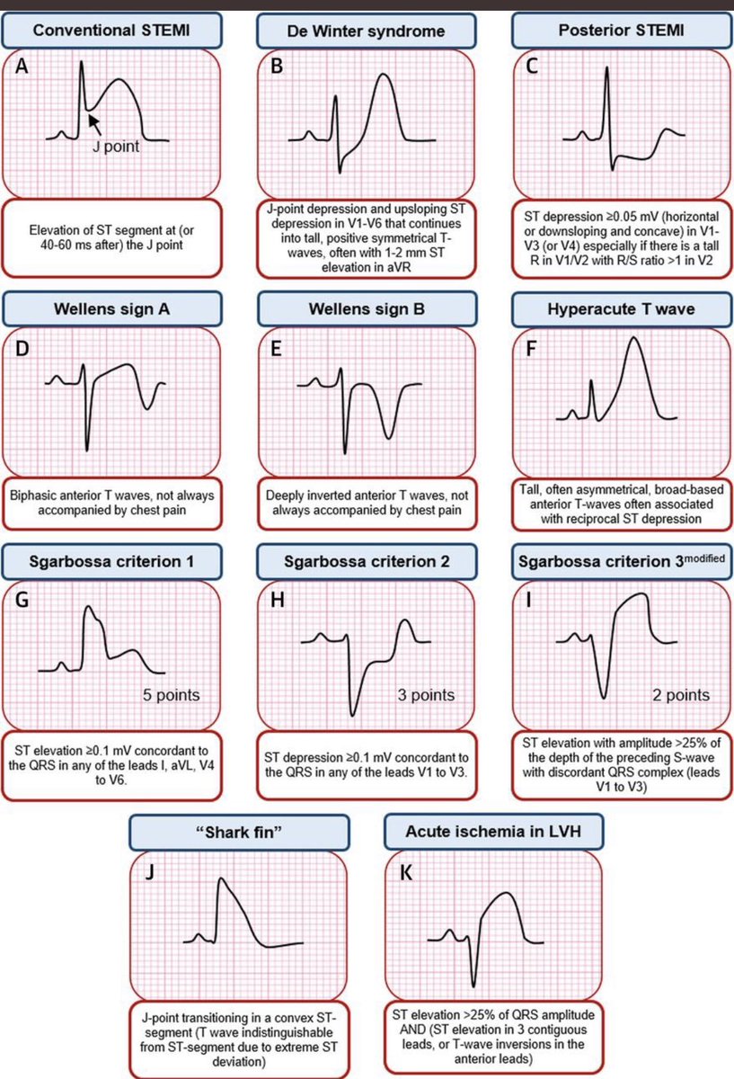 En medicina una de las cuestiones más importantes es saber diagnosticar la isquemia cardiaca porque es la causa más importante de arritmias ventriculares fatales. jacc.org/doi/10.1016/j.…