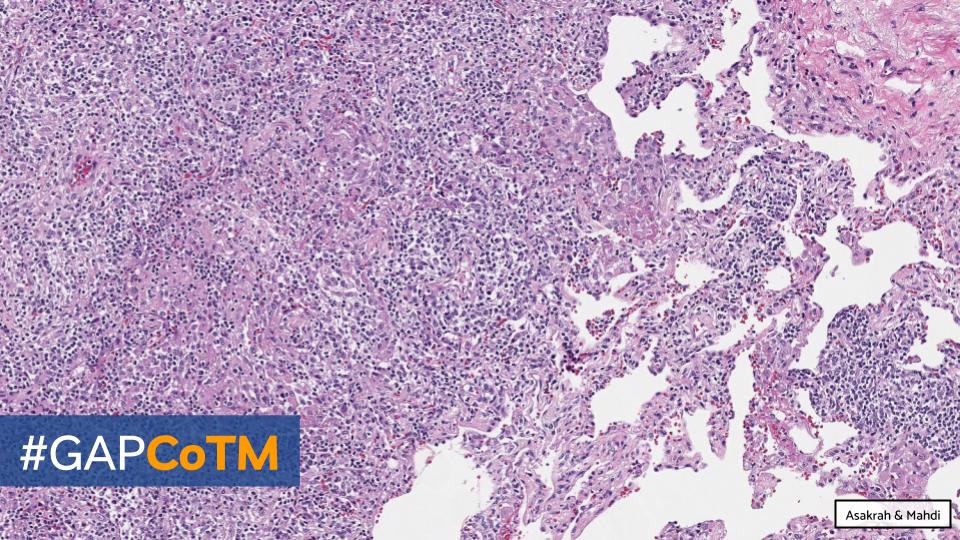 GAPathologists's tweet photo. GAP Case of the Month #14:
72βοΈ w/ lung & brain lesions, no LAD. Lung biopsy performed.
By: Dr.'s Saja Asakrah (@SAsakrah) & Zaid Mahdi (@zaid_mahdi)
π¬ WSI: https://t.co/huVFXkiv4g
π‘ Answer: https://t.co/8XVqtLvAne
#GAPCoTM #hemepath #lungpath #thoracicpath @EmoryPathology https://t.co/ZgU7KgJQiw