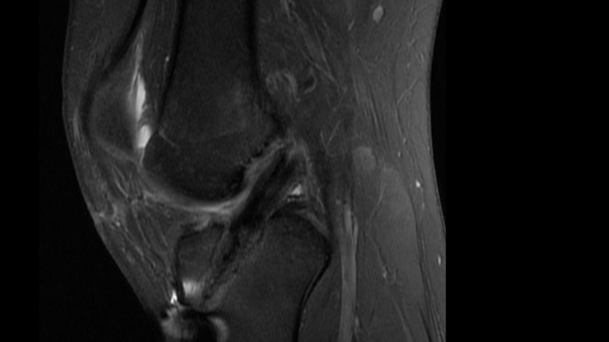 ArthrexMedEd's tweet photo. In today’s #WhatsNewAtArthrex, Chad D. Lavender, MD, shares clinical outcomes from multiple studies, including a prospective randomized study, comparing biologically augmented ACL reconstructions with a control group. Watch: https://t.co/HRDohGVqxz https://t.co/wQ6lfeNBny