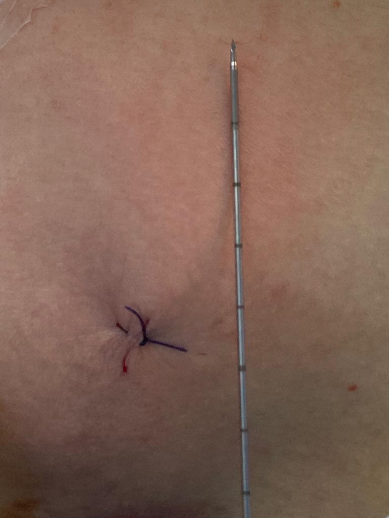 d_dorucu's tweet photo. Case of the day 
16Fr/20Fr ECIRS with TFL, exit strategy ureteral stent on a string
Result: Endoscopic and floroscopic stone free.
By @ytanidir, @MarmaraUroloji https://t.co/PcuL5IgD32