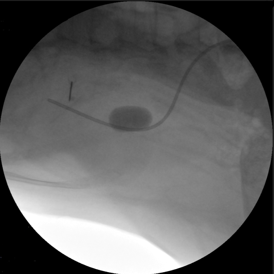 d_dorucu's tweet photo. Case of the day 
16Fr/20Fr ECIRS with TFL, exit strategy ureteral stent on a string
Result: Endoscopic and floroscopic stone free.
By @ytanidir, @MarmaraUroloji https://t.co/PcuL5IgD32