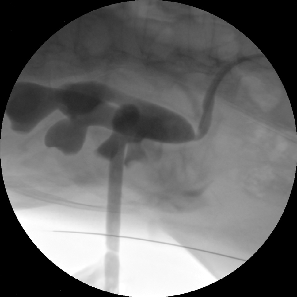 d_dorucu's tweet photo. Case of the day 
16Fr/20Fr ECIRS with TFL, exit strategy ureteral stent on a string
Result: Endoscopic and floroscopic stone free.
By @ytanidir, @MarmaraUroloji https://t.co/PcuL5IgD32