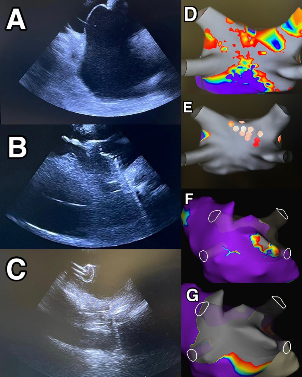 dkenigsberg's tweet photo. Used the SafeCross™ sheath to perform transseptal puncture (without the need for a needle or sheath exchange) to map and ablate the left atrium endocardially during a Convergent hybrid #AFib #ablation with @cardiacerik Dr. Erik Beyer @FloridaMedCtr this am. https://t.co/ICEkT2gmi3