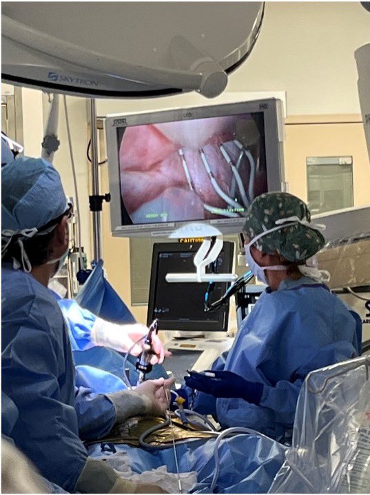 dkenigsberg's tweet photo. Used the SafeCross™ sheath to perform transseptal puncture (without the need for a needle or sheath exchange) to map and ablate the left atrium endocardially during a Convergent hybrid #AFib #ablation with @cardiacerik Dr. Erik Beyer @FloridaMedCtr this am. https://t.co/ICEkT2gmi3