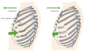 #Flail_chest — defined as two or more contiguous rib fractures with two or more breaks per rib — is one of the most serious of these injuries and is often associated with considerable morbidity and mortality.