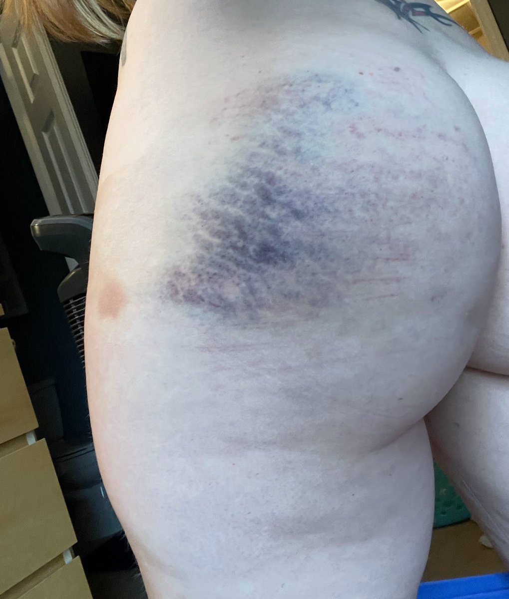 theMollyTate's tweet photo. My pretty bruises 🥰 https://t.co/5ihZ3Gsmjy