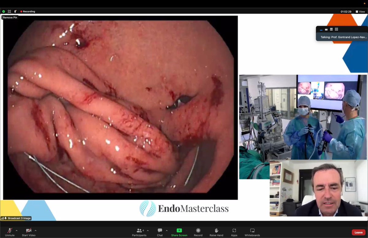 RomanTurro's tweet photo. Great conference and great time with good friends @Ivoboskoski Dr Huberty and Dr Formiga. Performed a great case of Endomegaplication with the IOP platform. #endomasterclass #bariatricendoscopy @Clinica_Teknon @TerapiasObesid https://t.co/0loR9LIfwB