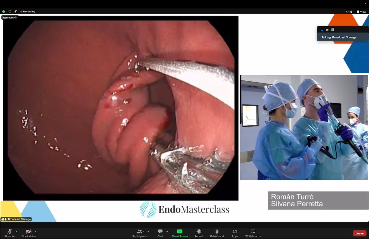 RomanTurro's tweet photo. Great conference and great time with good friends @Ivoboskoski Dr Huberty and Dr Formiga. Performed a great case of Endomegaplication with the IOP platform. #endomasterclass #bariatricendoscopy @Clinica_Teknon @TerapiasObesid https://t.co/0loR9LIfwB