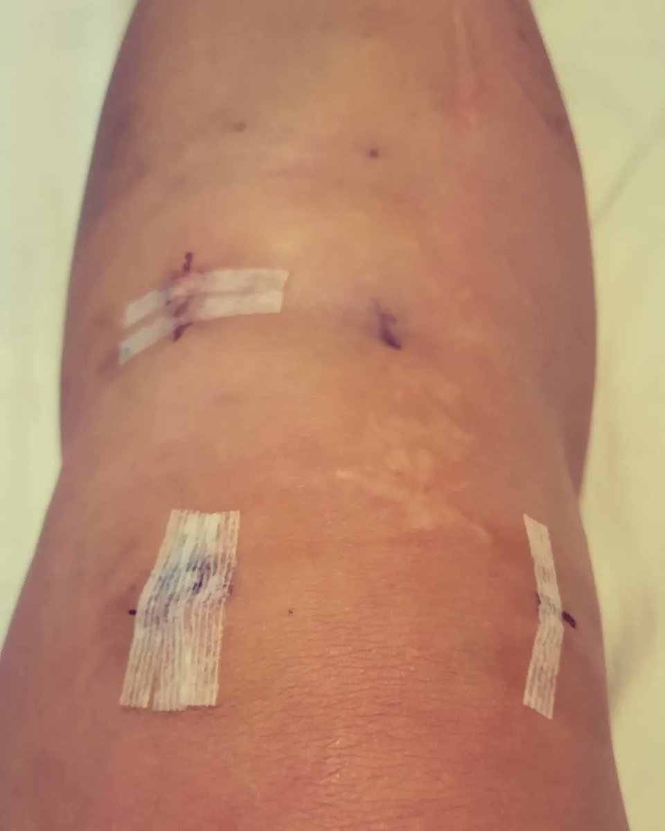 Rusteia's tweet photo. Not my first scar but definitely my first #kneesurgery!! Cleaning the wounds this morning! #woundcare #kneejourney #meniscalrootrepair 😷🦵🏽🩹 https://t.co/bC5bZxO1w5