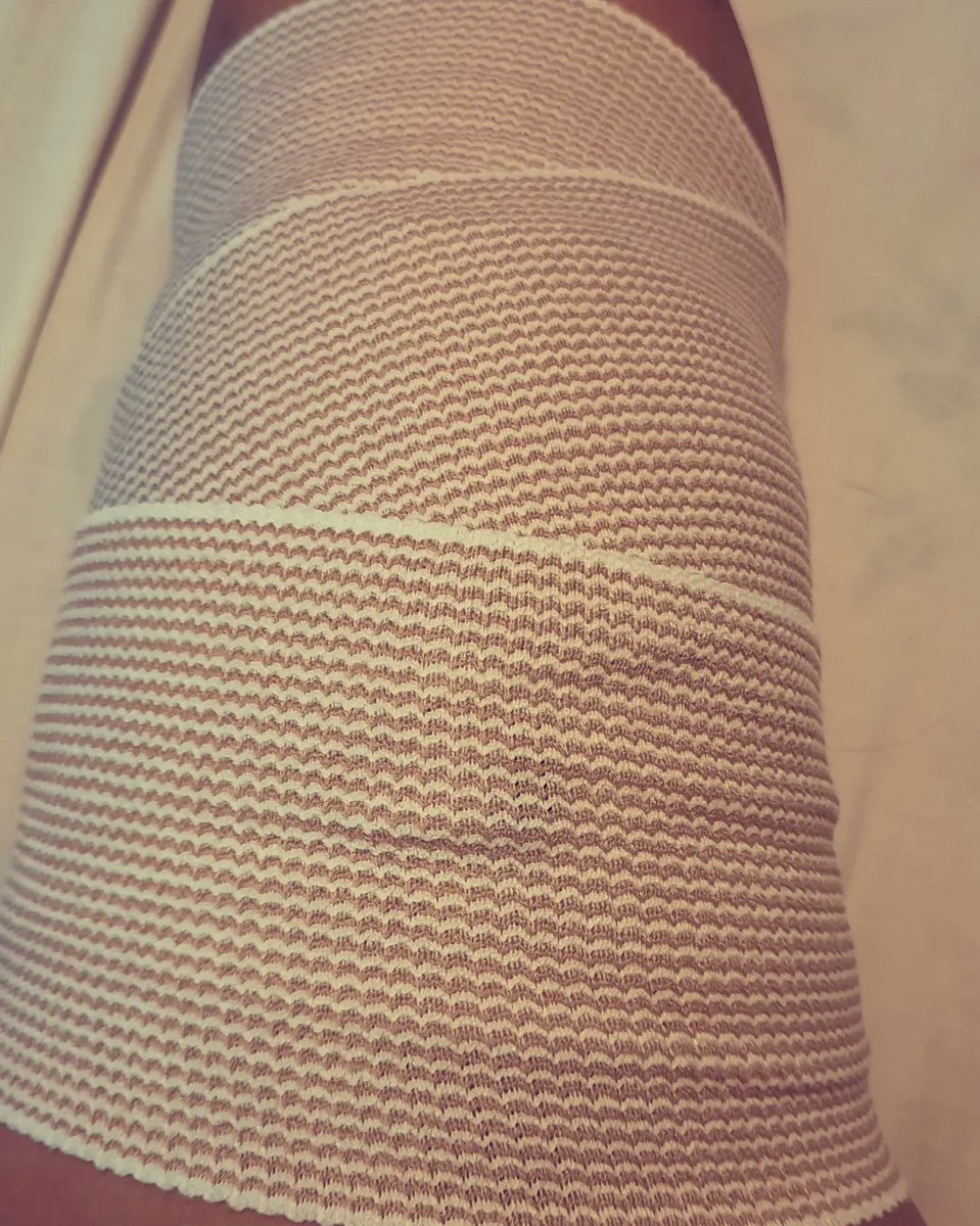 Rusteia's tweet photo. Not my first scar but definitely my first #kneesurgery!! Cleaning the wounds this morning! #woundcare #kneejourney #meniscalrootrepair 😷🦵🏽🩹 https://t.co/bC5bZxO1w5