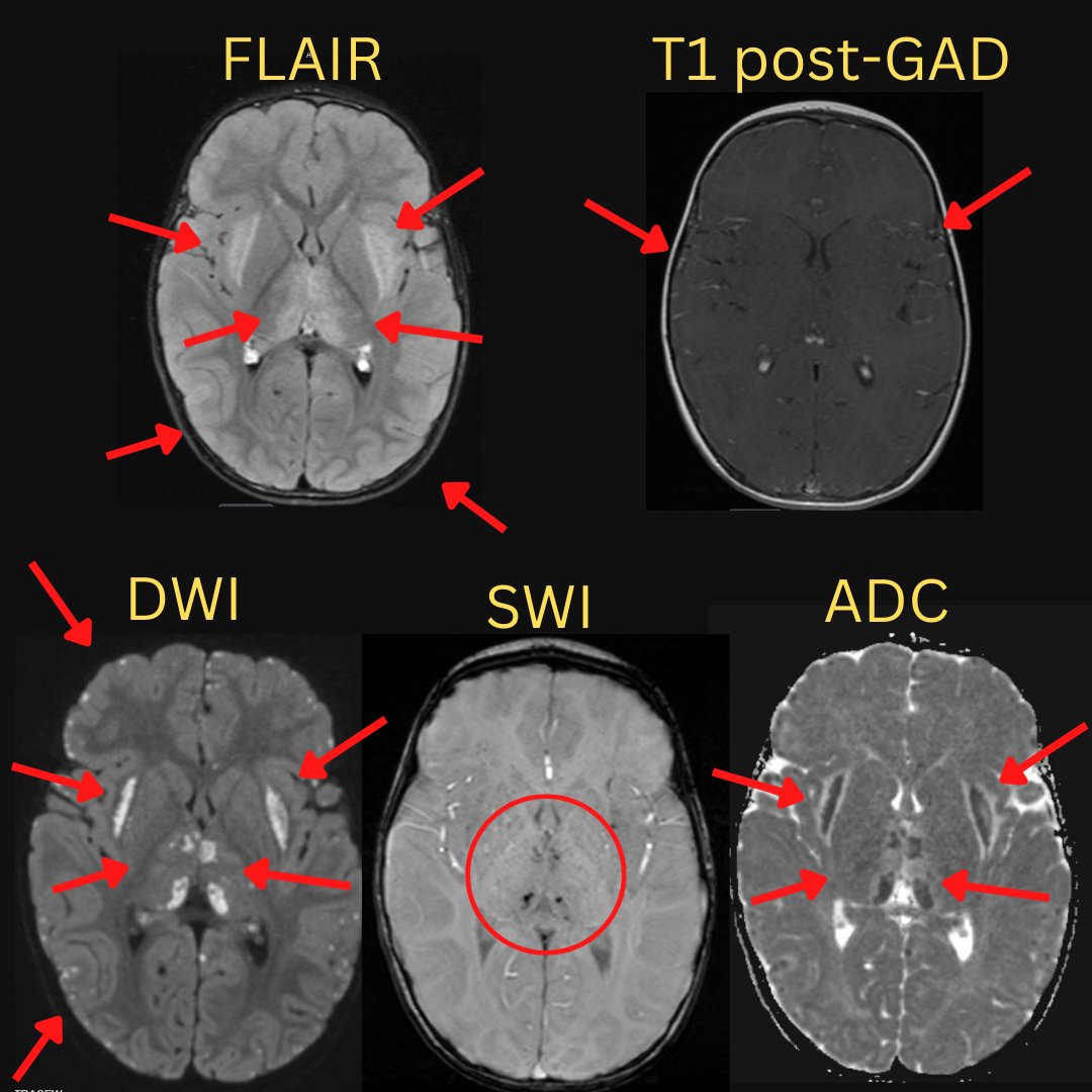 NeuroimagingN's tweet photo. Acute necrotizing encephalopathy of childhood (ANEC)

#acutenecrotizingencephalopathyofchildhood #ANEC #ADEMlike #neuroimmunology #neurotwitter #MedEd https://t.co/lhDzoitOTn