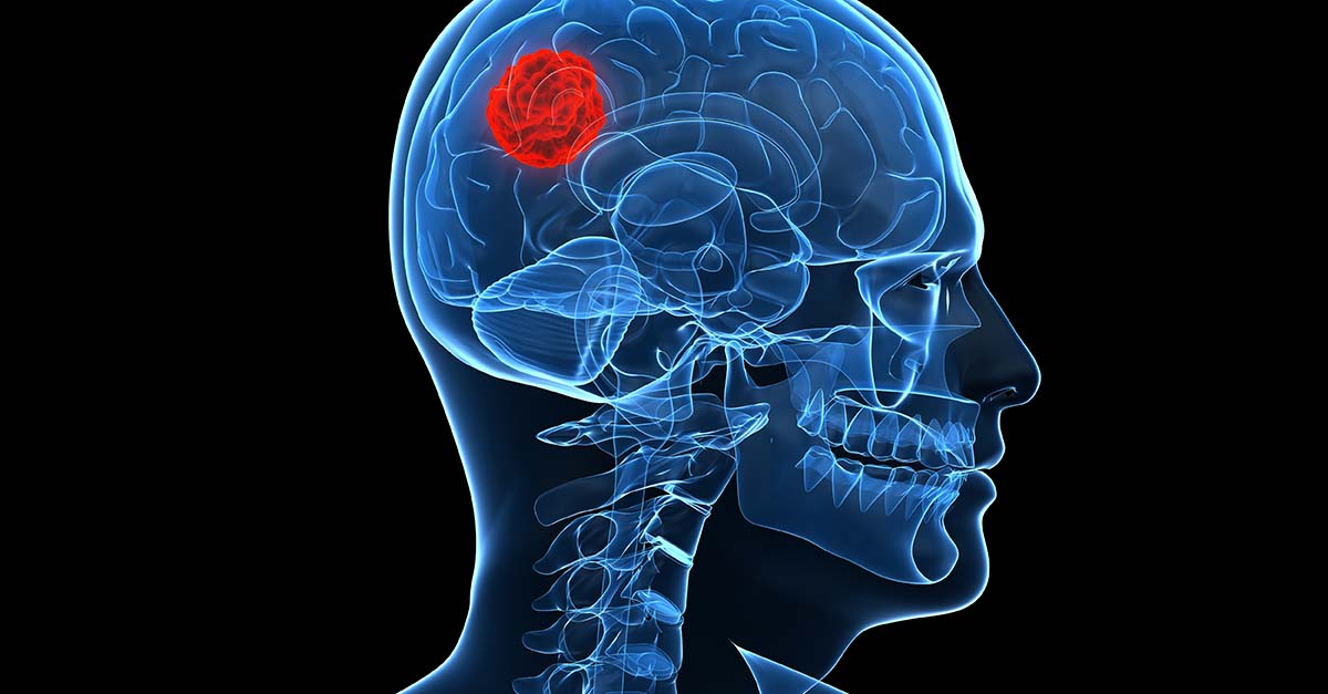 SonALAsense's tweet photo. What is SonALAsense #SonodynamicTherapy? SDT is a noninvasive targeted combination of a drug (SONALA-001) &amp; MR-guided focused ultrasound being developed. Our goal is to turn #cancer from a deadly to a chronic disease — &amp; cancer patients into survivors. https://t.co/ESat5l6MxV https://t.co/ioaDcFUnUZ