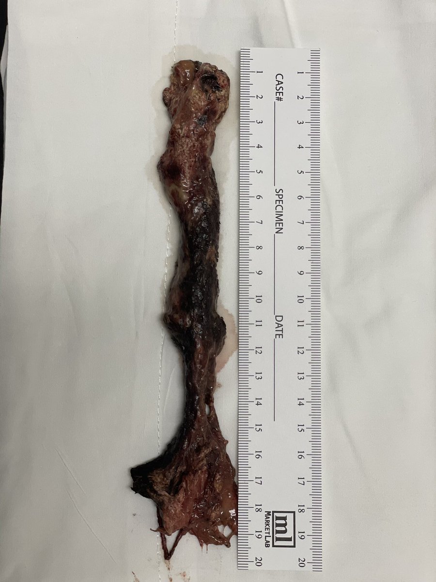 David Diehl (@daviddiehlmd) on Twitter photo Had to share…unbelievably long pancreatic necrosum that I pulled out through a 20mm LAMS. Saving it for the Mütter Museum in Philly! <a href="/MutterMuseum/">Mütter Museum</a> <a href="/DouglasAdlerMD/">Douglas G. Adler MD, FASGE, FACG, AGAF</a> <a href="/tberzin/">Tyler Berzin MD, FASGE</a> <a href="/drkeithsiau/">Keith Siau</a> Had to share…unbelievably long pancreatic necrosum that I pulled out through a 20mm LAMS. Saving it for the Mütter Museum in Philly! <a href="/MutterMuseum/">Mütter Museum</a> <a href="/DouglasAdlerMD/">Douglas G. Adler MD, FASGE, FACG, AGAF</a> <a href="/tberzin/">Tyler Berzin MD, FASGE</a> <a href="/drkeithsiau/">Keith Siau</a>