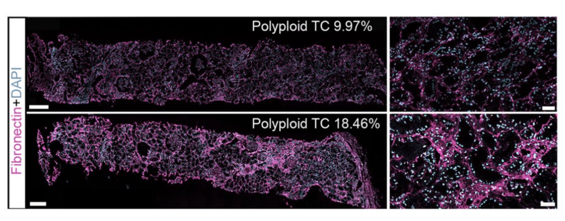 Polyploid tubular cells save the patient life early in AKI recovering function by hypertrophy but they turn senescent on the long run promoting kidney fibrosis and CKD. nature.com/articles/s4146…