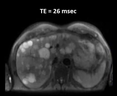 SMRIT_3's tweet photo. 💡- DWI in Liver vs Echo time (TE). https://t.co/kgZOxdLkOb