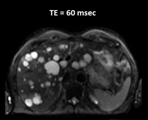 💡- DWI in Liver vs Echo time (TE).