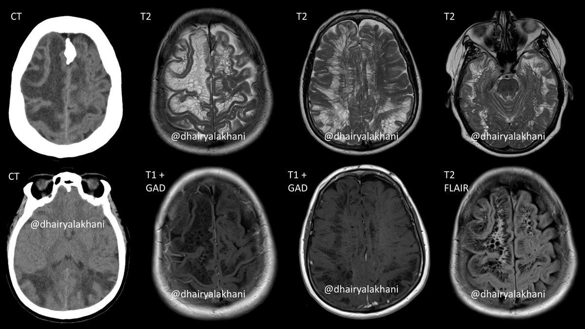 Middle-aged woman presents w trauma
✅CT: No bleed, diffuse WM changes
✅MR: Innumerable cystic foci extending to subcortical WM. Slight increased peri-lesional FLAIR signal. No enhancement. GM is stretched &amp; displaced
✅Diagnosis: Giant Tumefactive Perivascular Spaces
#RadRes