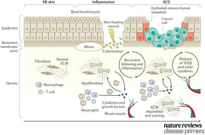 DrImranSheikh's tweet photo. Certain types of #epidermolysis #bullosa are associated with an increased risk of developing cutaneous #squamous cell #carcinoma 
https://t.co/jimQ5KhOjw https://t.co/UxPJ4Ym9eq