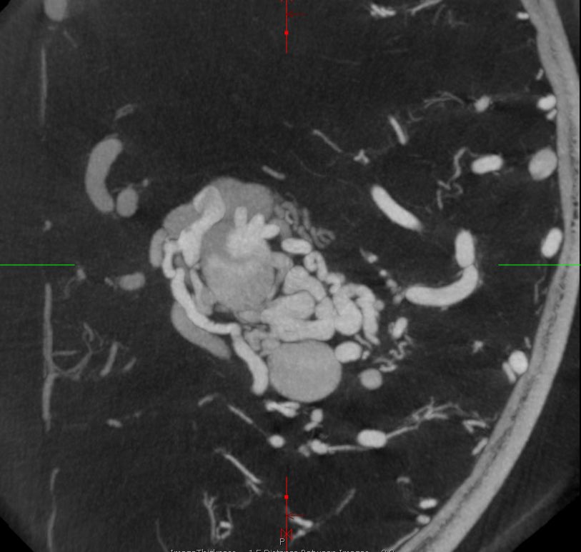 GammaNyu's tweet image. #DynaCT  for Volume Staged Gamma Knife Radiosurgery @DKondziolkaCNS 
@DrRot @eytanraz @neuroangio1 @ENossek @juandiegoneuro @NYUneurosurgery @NYULH_RadOnc