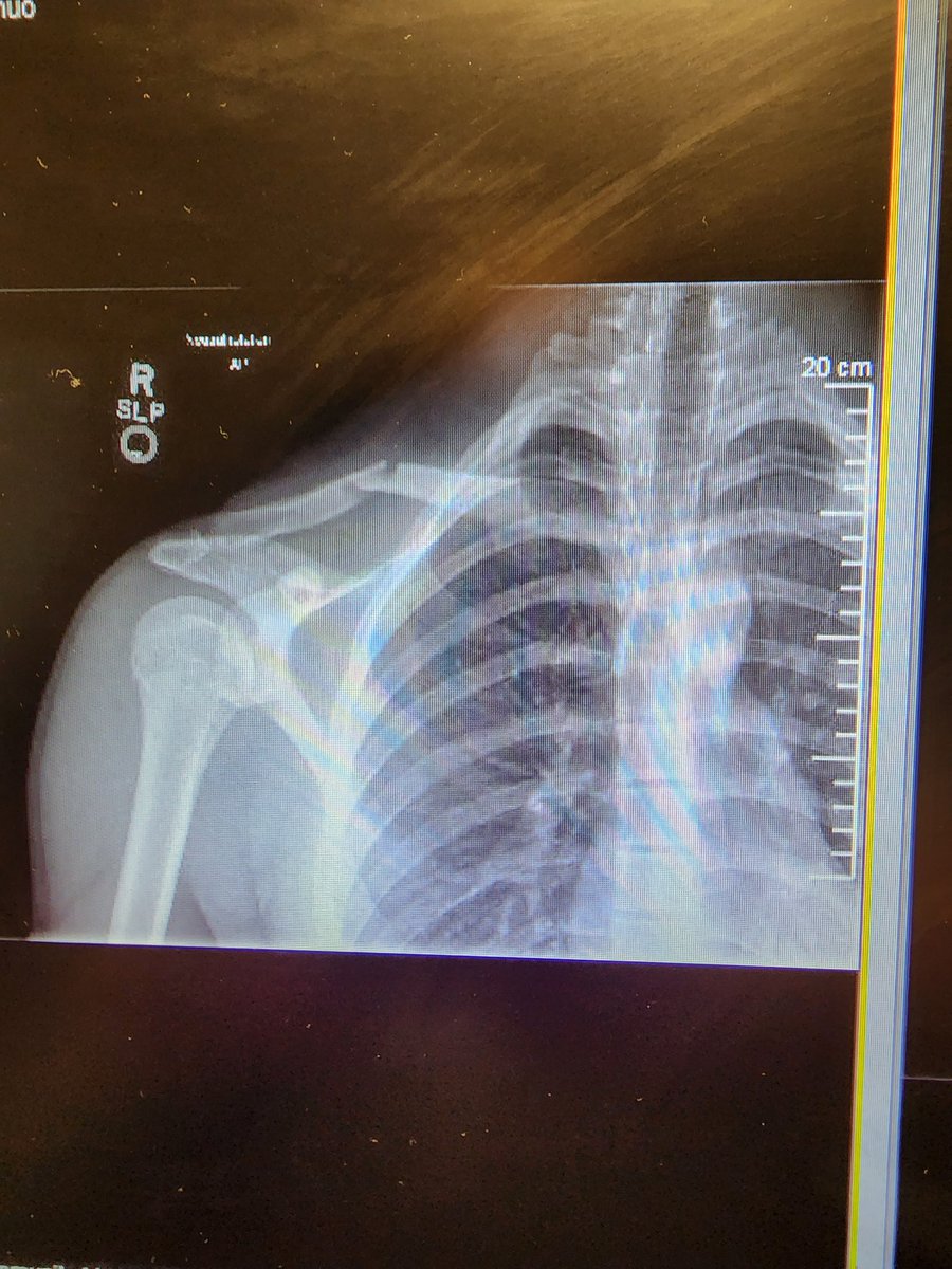 Senior year of football done for TJ. Boken clavicle at practice. Heal up buddy. In pain still but his focus now is healing in time for snowboarding season.