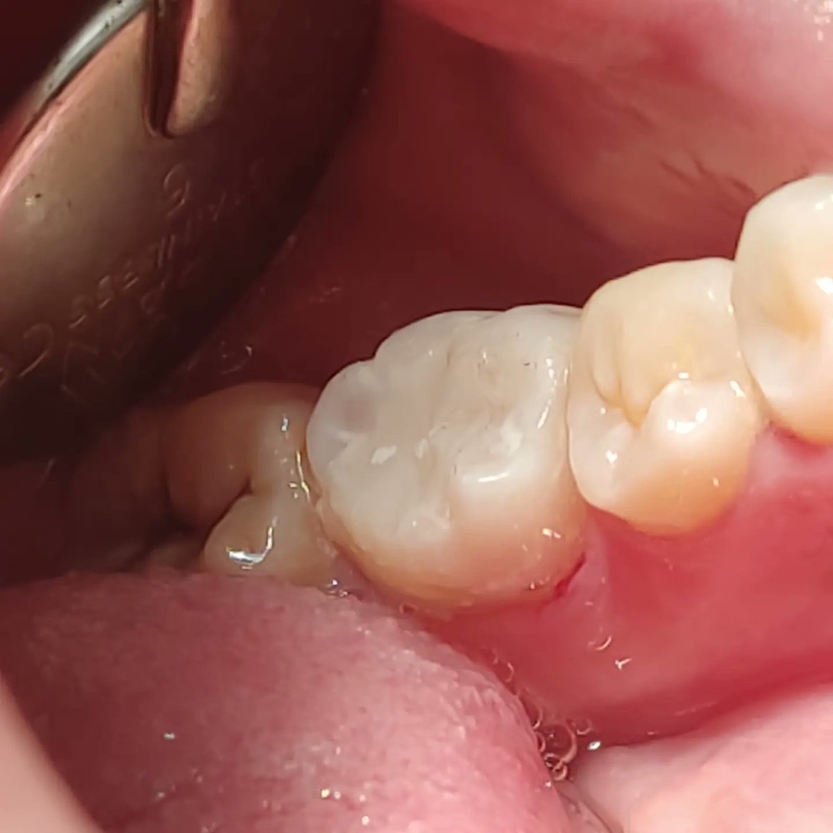 drluisurra's tweet photo. El antes y después de una restauración profunda con vitrebond y resina bulk 3M #dentista #odontologia #dientesblancos #dentistry #stunningsmile #cadcam #Irapuato #guanajuato #dentist #endodoncia #rootcanal #protesisdental #bichectomia #esteticadental https://t.co/WKKQ1iuZKk
