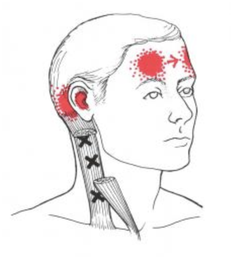 PBClinic's tweet photo. There are many causes of #headaches, don't carry on suffering...

A common places to begin looking for triggers of headache is the neck region. Trigger points in neck muscles are the most common cause for headaches we see.

99% of these respond to simple intervention! 

#PBC360 https://t.co/z5bfTfUUG7