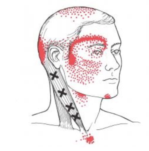 PBClinic's tweet photo. There are many causes of #headaches, don't carry on suffering...

A common places to begin looking for triggers of headache is the neck region. Trigger points in neck muscles are the most common cause for headaches we see.

99% of these respond to simple intervention! 

#PBC360 https://t.co/z5bfTfUUG7