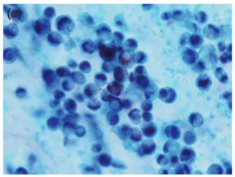 CytopathologyJ's tweet photo. Q041. A 70-year-old anorexic patient presented with a 3.5cm lesion at the head of pancreas. #ERCP showed stenosis and dilatation of the main pancreatic duct. Ductal brushing was obtained from the stenosed portion. What is your diagnosis? #CytoJ #CytoJQuiz #PancreasPath https://t.co/NfCAKHxPn4