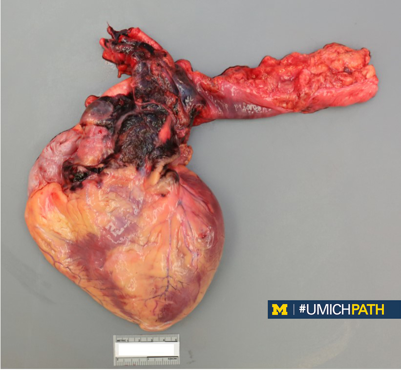 Michigan Pathology tweet media