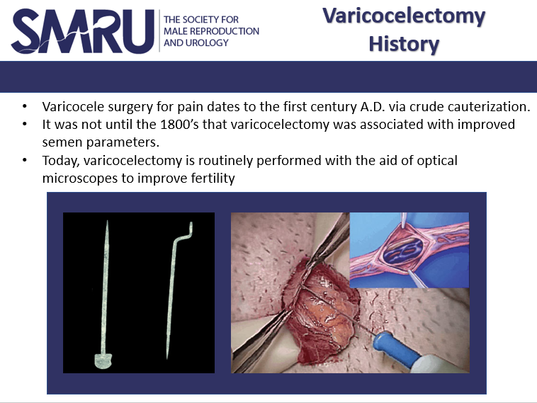 ReproMed_SMRU's tweet photo. #Varicocele surgery for pain dates to the first century A.D. via crude cauterization. It was not until the 1800’s that it was associated with improved semen parameters. Today, #varicocelectomy is routinely performed with the aid of optical microscopes to improve fertility https://t.co/gmGgS9oc7Y