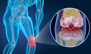 OrthogenRx's tweet photo. With Fall coming and a great time to be outside, find out how walking may lead to healthier knees.
https://t.co/CaK1nJlm28 https://t.co/hI0nfw4mUG
