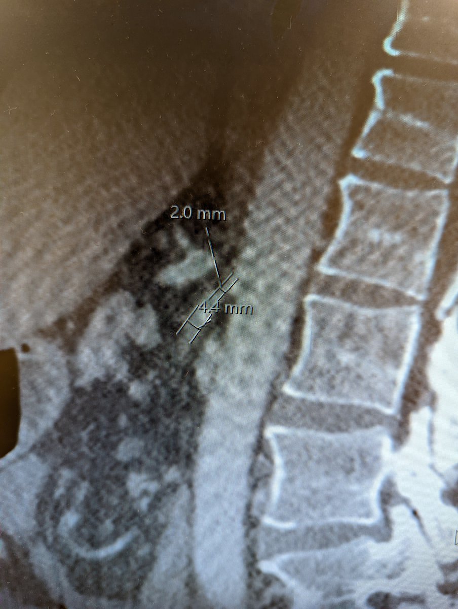 Dear #radiology, could you please refrain from adding permanent annotations right on top of the area of interest? Impossible to get a full view of the vessel now.