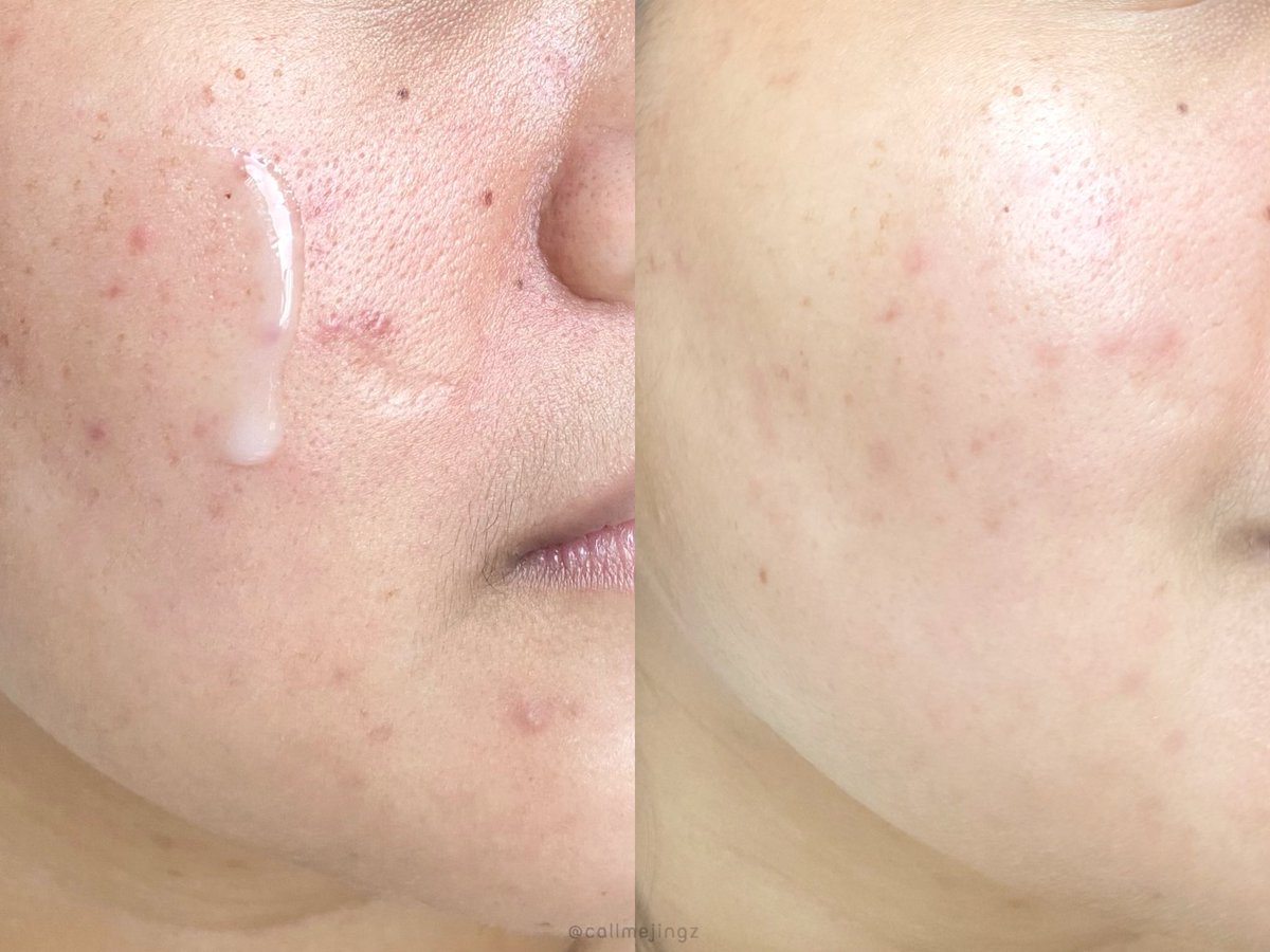 callmejingz's tweet photo. จับคู่ตำนานสกินแคร์ลดสิวบอกเลยว่าปังง ยิ่งใช้เซรั่ม Merci ทุกวันนะ สิวลดลงไวมากอะ เมื่อก่อนใช���บ่อยมาก จนสิวกลับมาเลยหยิบมาใช้อีก ช่วยลดสิวต่างๆ ได้ดี แถมหน้าสว่างขึ้นด้วย ใช้คู่กันคือผิวดีขึ้นจริงง #ใช้จริงรีวิวจริง #ใช้ดีบอกต่อ https://t.co/WSUY8n42DM