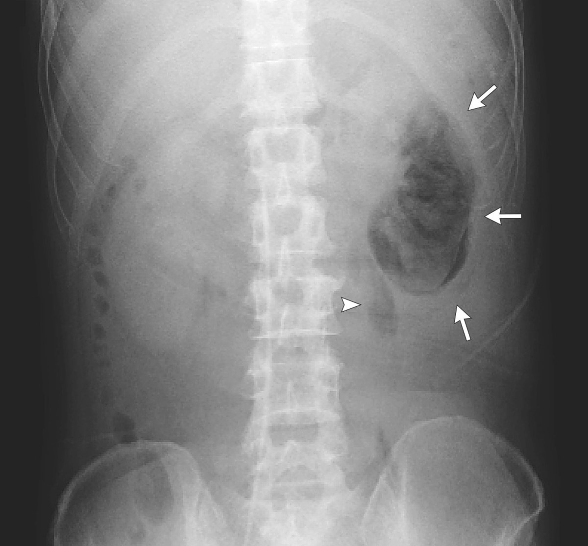 Manual Of Medicine On Twitter A 51 Year Old Male With Diabetes Presented With 2 Weeks Of