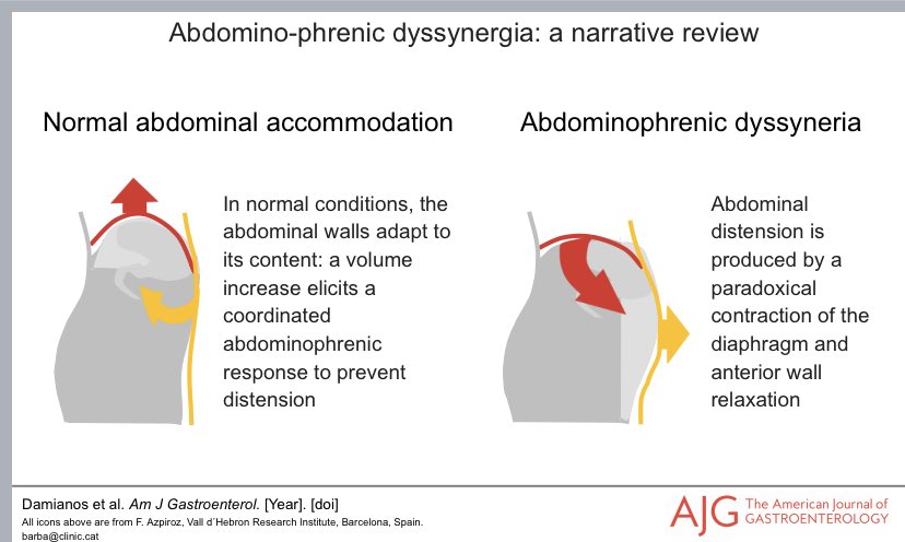 john_damianosMD's tweet photo. Very excited to share our review on abdomino-phrenic dyssynergia! 

🎈This physiology is an important contributor to bloating and distension in disorders of gut-brain interaction! 

#MedTwitter #GITwitter #DGBI #FGID #IBS @AmJGastro 

https://t.co/nylhtB5uPq https://t.co/7vsVkHatbu
