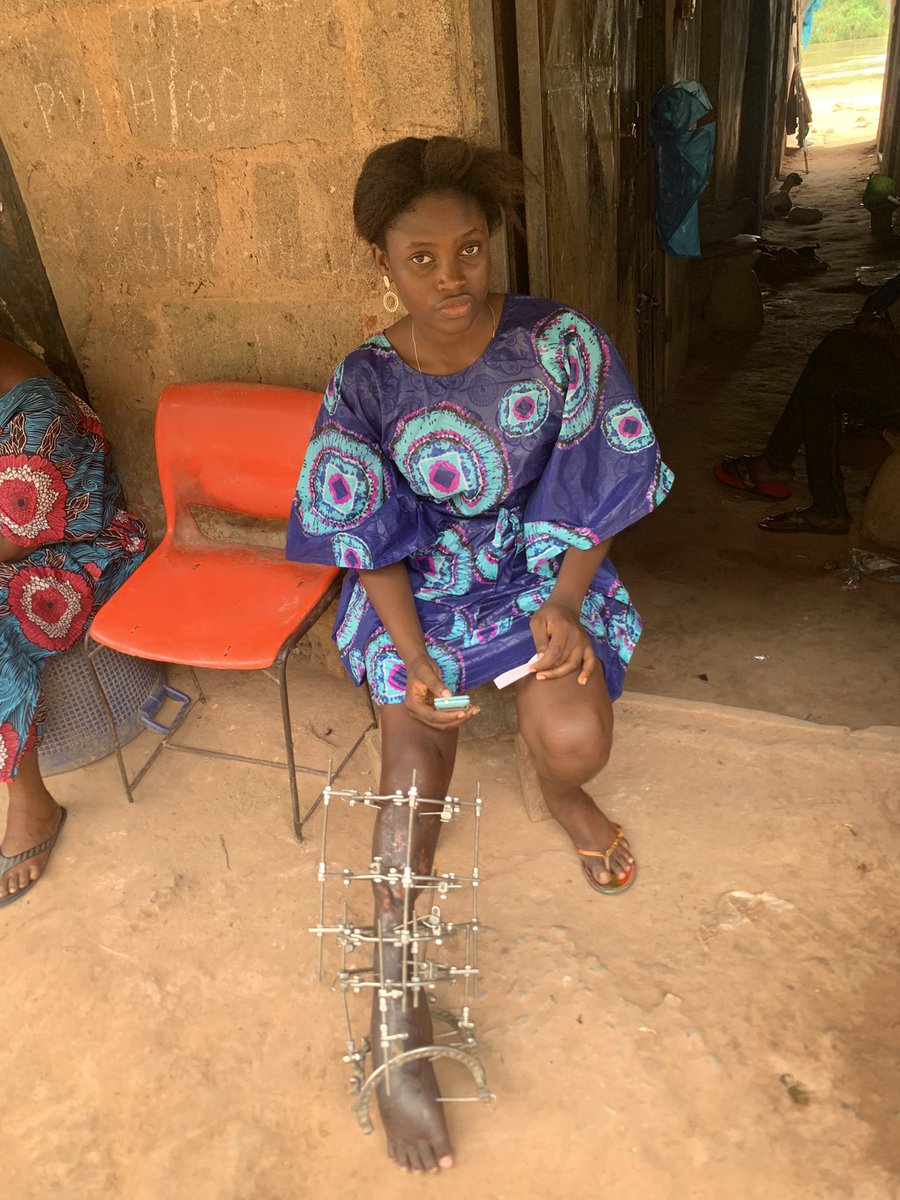 TheAjakeManger's tweet image. BREAKING:
I met Anuoluwapo yesterday &amp;amp; was touched to my marrows by her story. It was a bitter sweet experience for me. She had an accident in 2018 that fractured her leg &amp;amp; totally altered her life. Her dad left after he could no longer provide &amp;amp; She lost her mum to sickness.