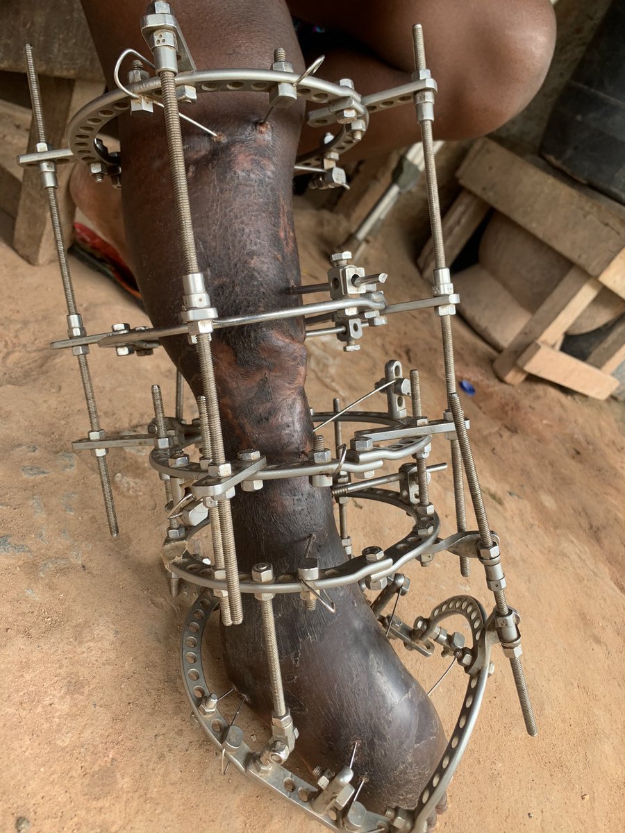 TheAjakeManger's tweet image. BREAKING:
I met Anuoluwapo yesterday &amp;amp; was touched to my marrows by her story. It was a bitter sweet experience for me. She had an accident in 2018 that fractured her leg &amp;amp; totally altered her life. Her dad left after he could no longer provide &amp;amp; She lost her mum to sickness.