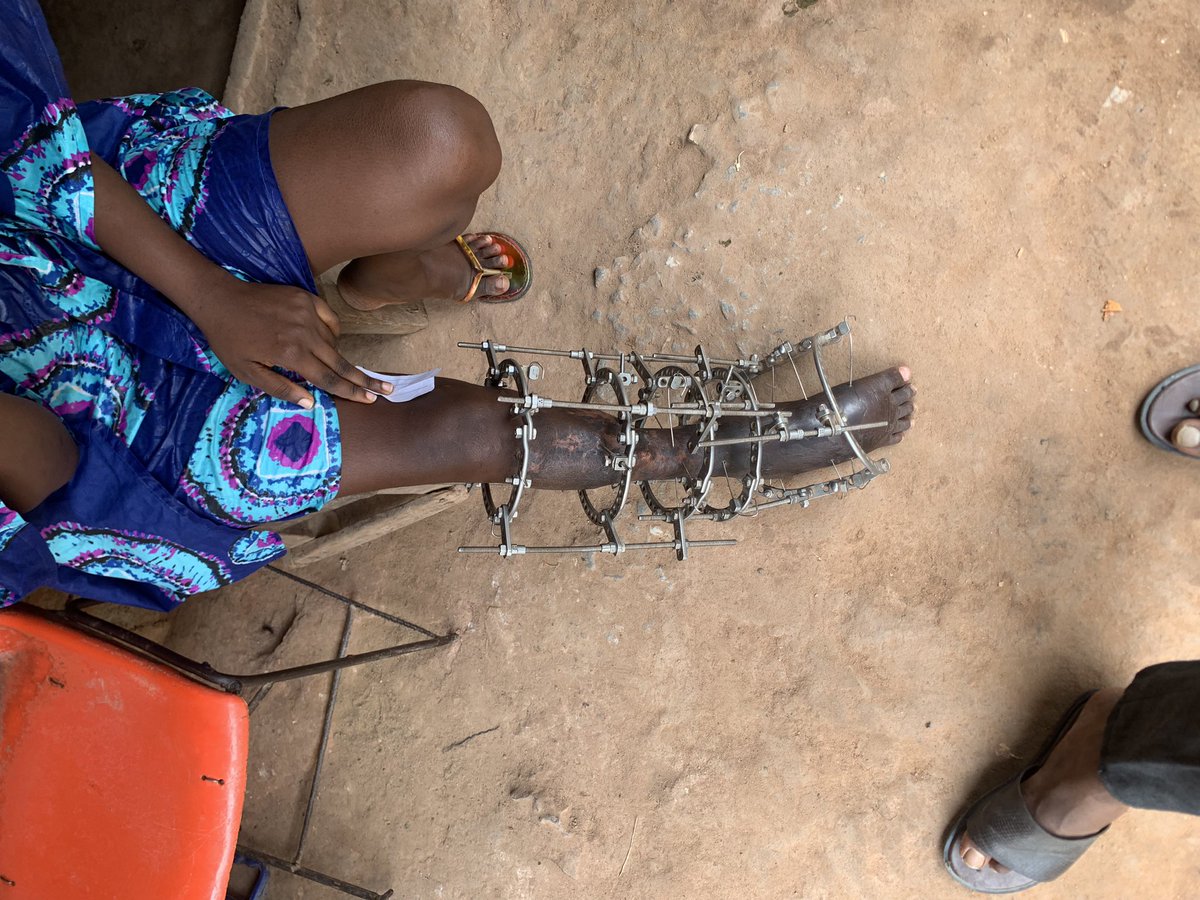 TheAjakeManger's tweet image. BREAKING:
I met Anuoluwapo yesterday &amp;amp; was touched to my marrows by her story. It was a bitter sweet experience for me. She had an accident in 2018 that fractured her leg &amp;amp; totally altered her life. Her dad left after he could no longer provide &amp;amp; She lost her mum to sickness.