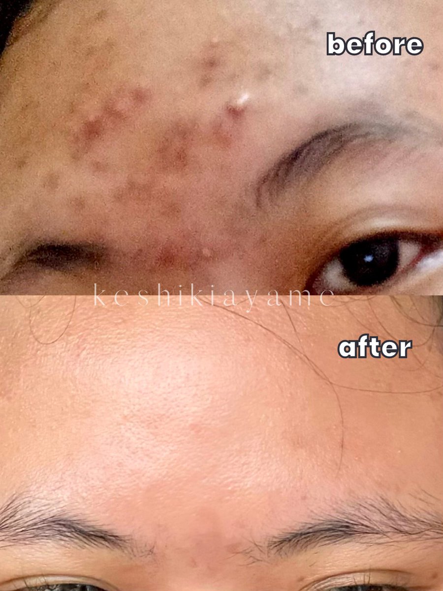 tau gak sih ini salah satu serum yg bantu bekas jerawatku cepet memudar!#racuninskincare Yang lagi struggle sama bekas jerawat plis kalian harus cobain ini! Sekarang udah improved formula jadi gak gampang oksidasi😭👍🏻 Bagus untuk : ✅buat bekas jerawat ✅untuk mencerahkan kulit