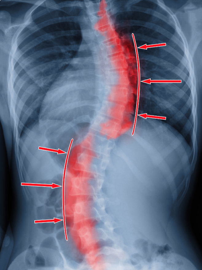 drcorenman's tweet photo. With #scoliosis, uneven wear can cause premature degenerative disc disease and facet arthritis. Eventually, #bonespur formation can cause nerve or even #spinalcord compression. https://t.co/9V1khXvRS7 #neckandback https://t.co/CIa7hQO6U1