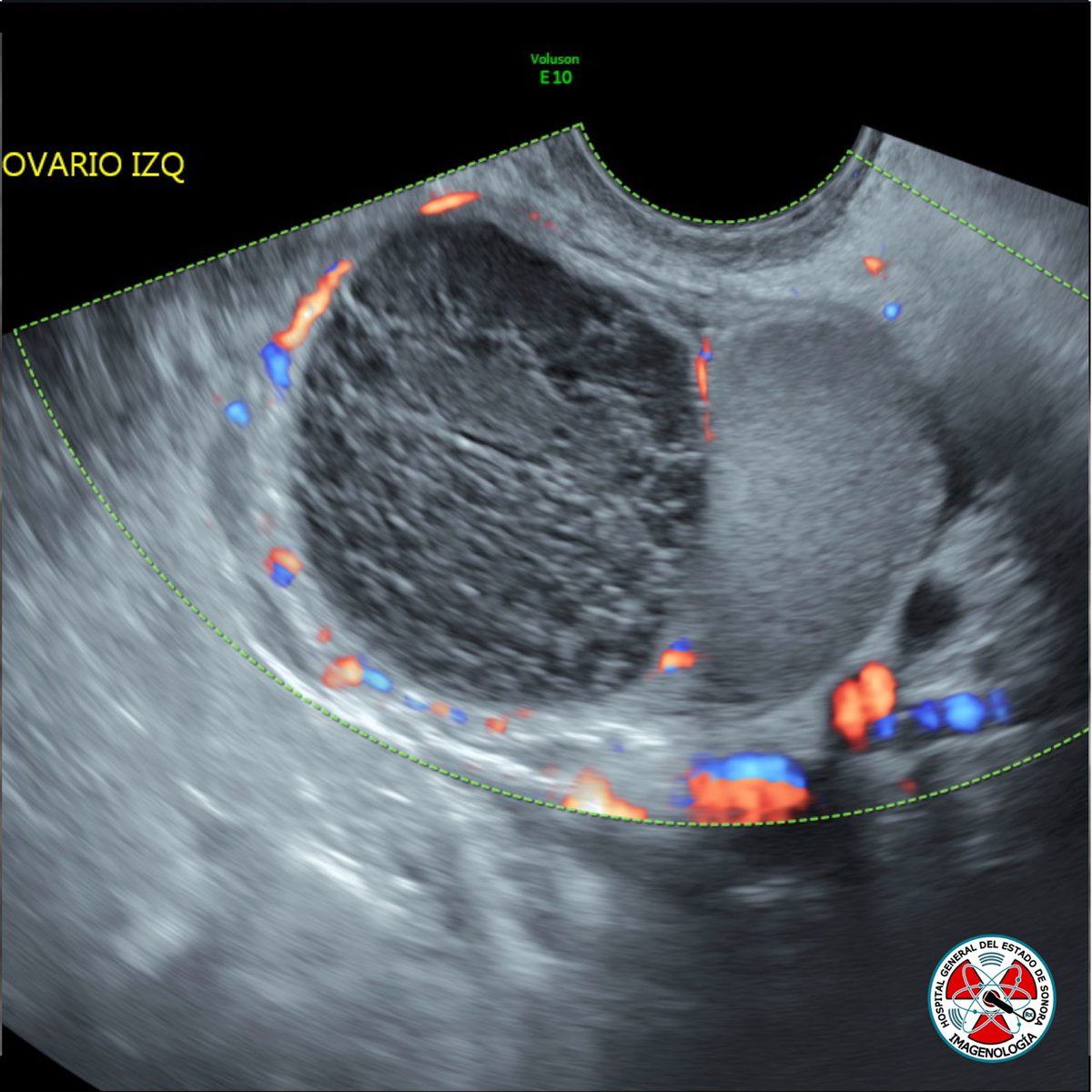 ¿Cuál es tu impresión diagnóstica? #radres #radiology #ultrasound  <a href="/arenas_ru2/">Daniel Arenas Ruiz</a>